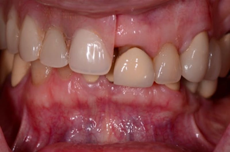 Revision Dental Implants  Before & After Gallery - Patient 108811757 - Image 2