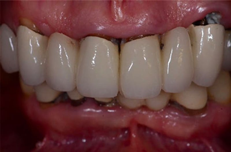 Revision Dental Implants  Gallery - Patient 108811758 - Image 2