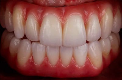 Revision Dental Implants  Before & After Gallery - Patient 108811758 - Image 1