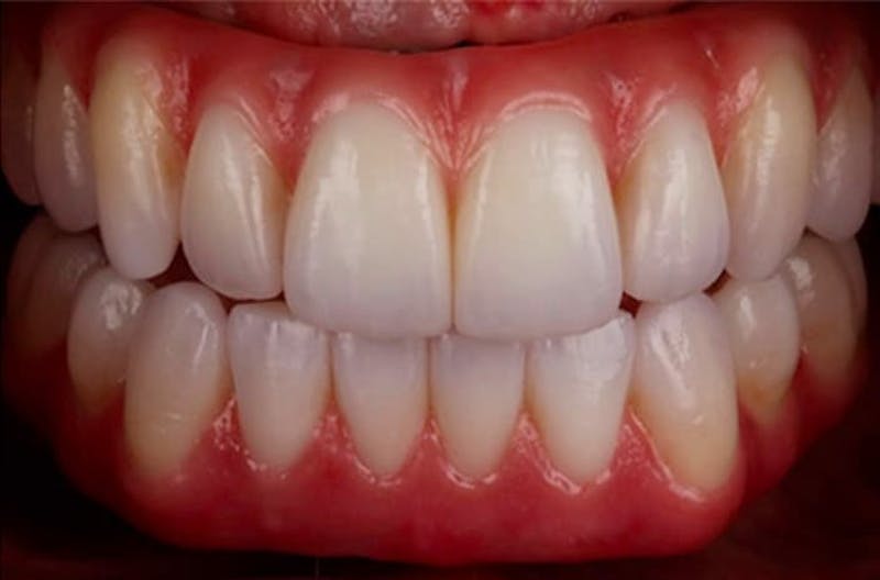 Revision Dental Implants  Gallery - Patient 108811758 - Image 1