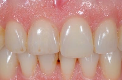 Other Procedures Before & After Gallery - Patient 108811928 - Image 2