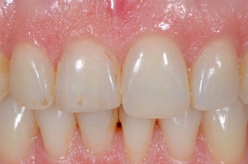 Other Procedures Before & After Gallery - Patient 108811928 - Image 2