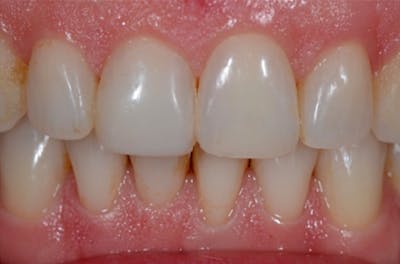 Other Procedures Before & After Gallery - Patient 108811928 - Image 1