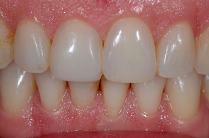 Other Procedures Before & After Gallery - Patient 108811928 - Image 1