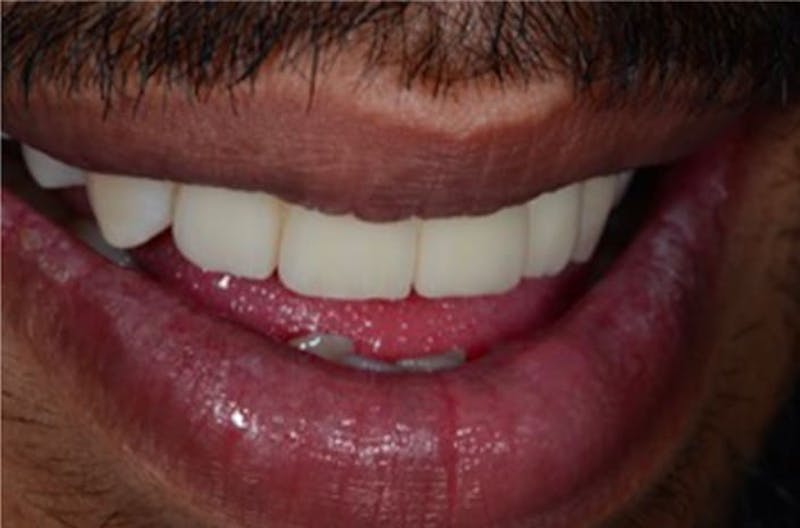 Other Procedures Before & After Gallery - Patient 108811929 - Image 1