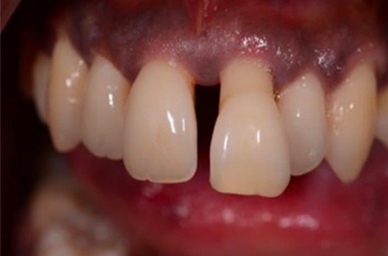 Other Procedures Before & After Gallery - Patient 108811929 - Image 2