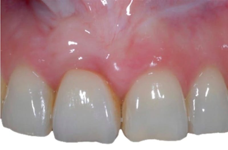 Other Procedures Before & After Gallery - Patient 108811930 - Image 1