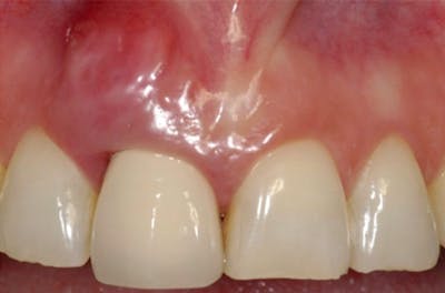 Other Procedures Before & After Gallery - Patient 108811930 - Image 2