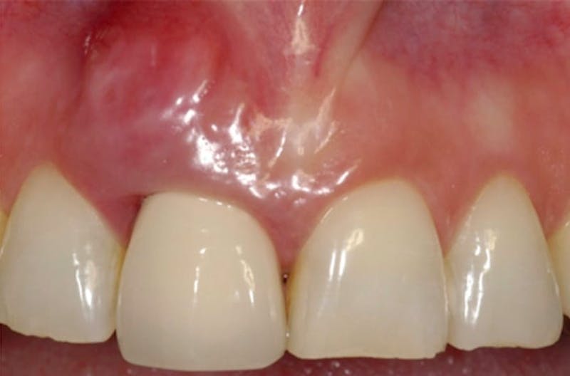 Other Procedures Before & After Gallery - Patient 108811930 - Image 2