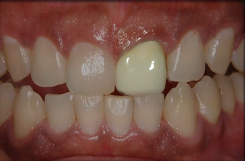 Other Procedures Before & After Gallery - Patient 108811931 - Image 1