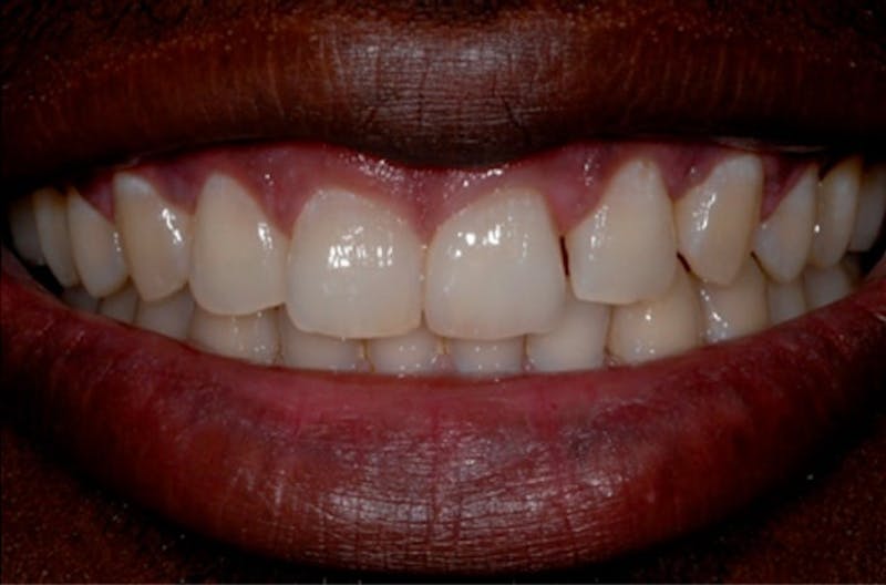 Other Procedures Before & After Gallery - Patient 108811931 - Image 2