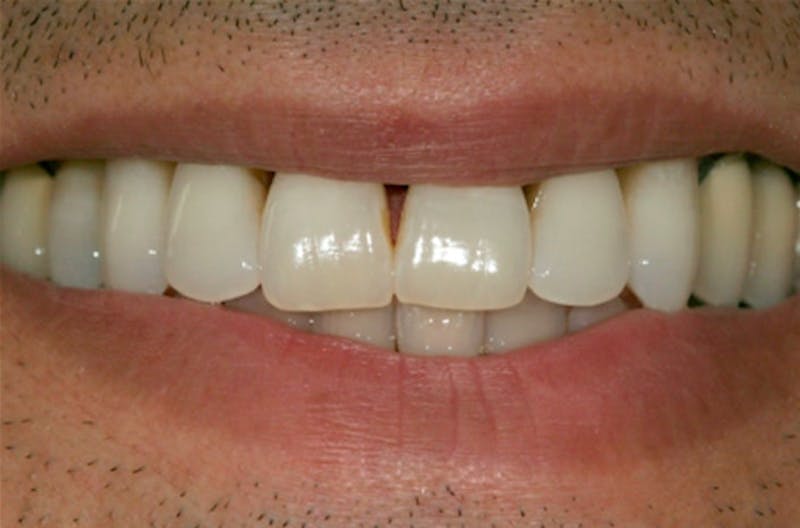 Other Procedures Before & After Gallery - Patient 108811932 - Image 2