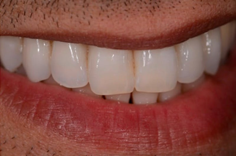 Other Procedures Before & After Gallery - Patient 108811932 - Image 1