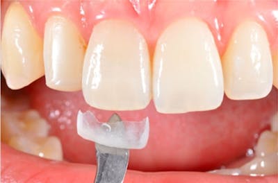 Other Procedures Before & After Gallery - Patient 108811933 - Image 2