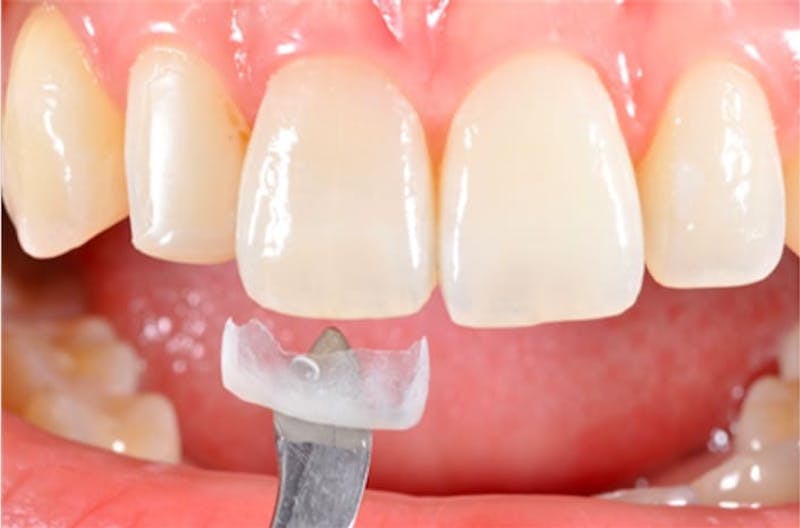 Other Procedures Before & After Gallery - Patient 108811933 - Image 2
