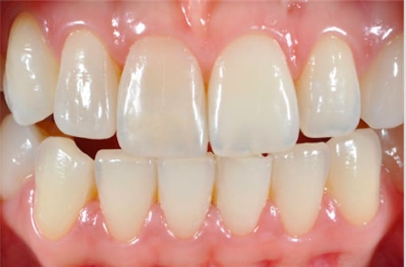Other Procedures Before & After Gallery - Patient 108811933 - Image 1