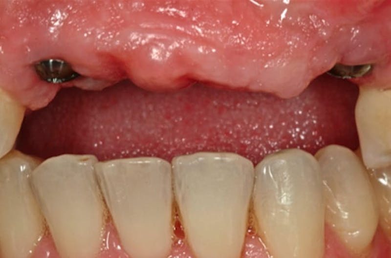 Other Procedures Before & After Gallery - Patient 108811934 - Image 2