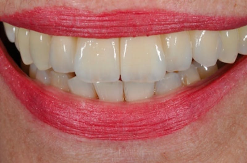 Other Procedures Before & After Gallery - Patient 108811934 - Image 1