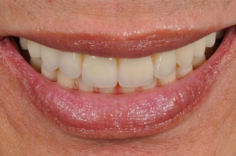 Other Procedures Before & After Gallery - Patient 108811935 - Image 1