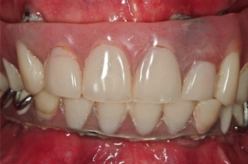 Other Procedures Before & After Gallery - Patient 108811935 - Image 2