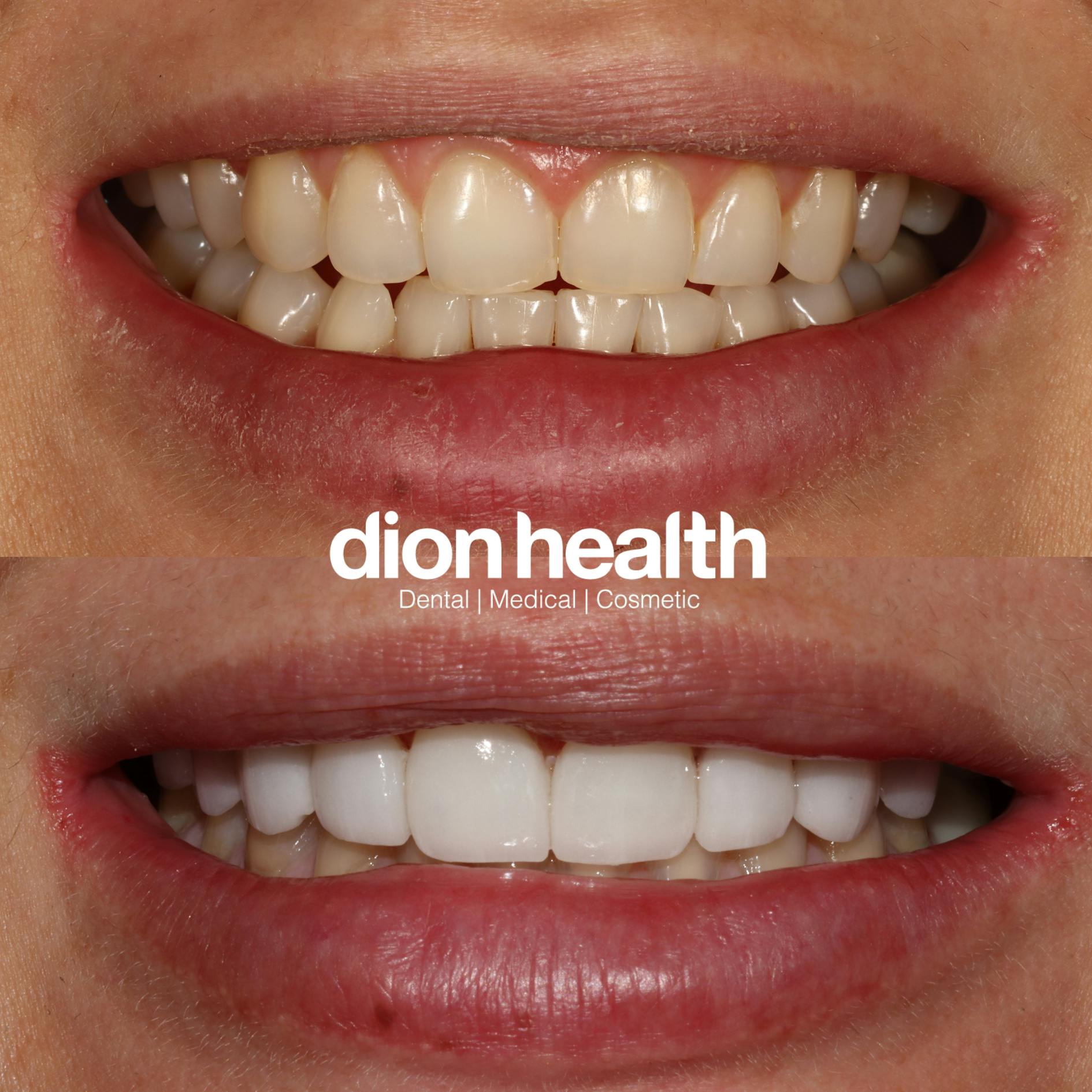 Smile Makeover Before & After Gallery - Patient 177618040 - Image 1