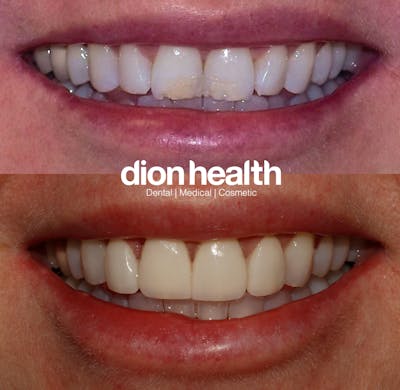 Smile Makeover Before & After Gallery - Patient 177618042 - Image 1
