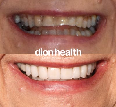 Smile Makeover Before & After Gallery - Patient 177618045 - Image 1