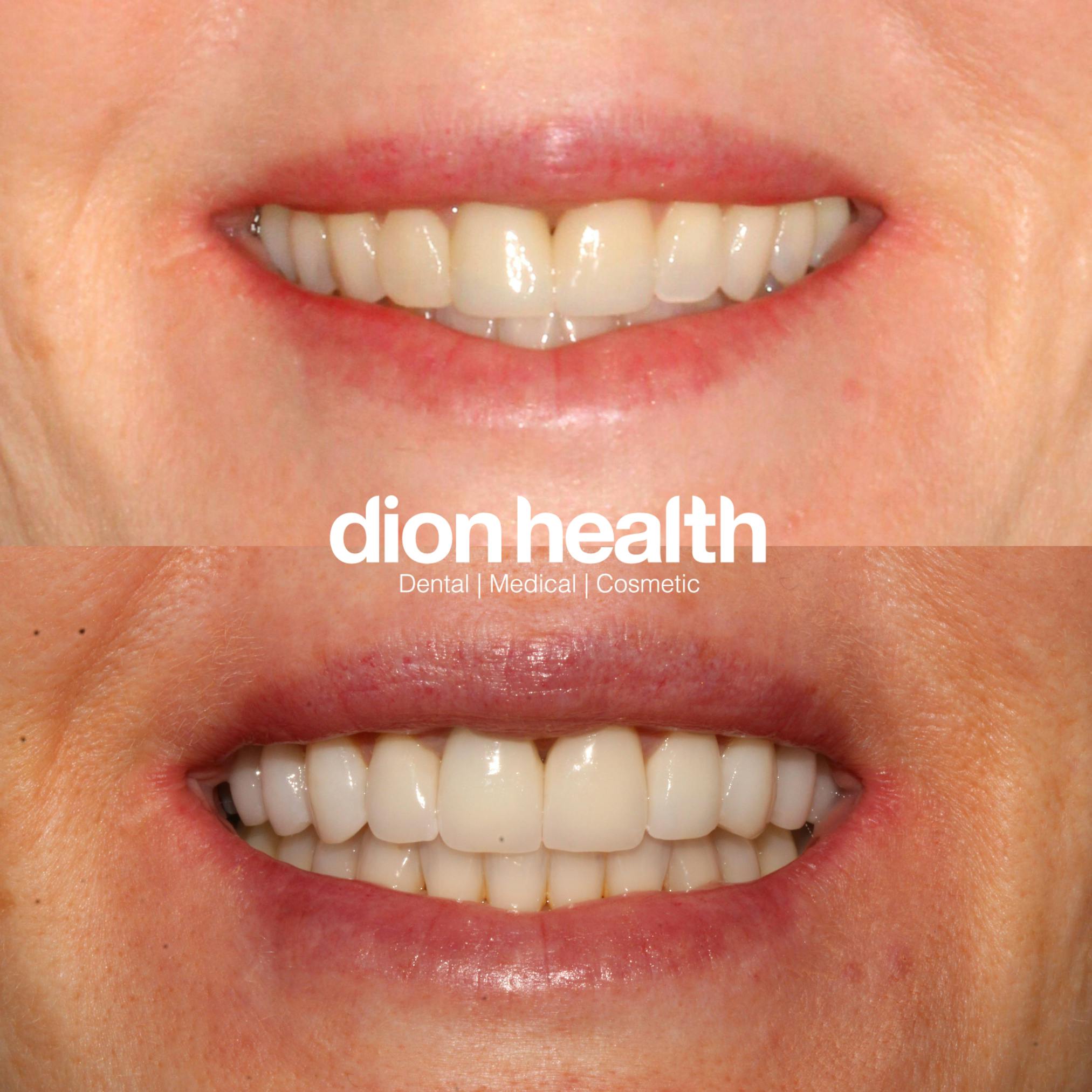 Smile Makeover Before & After Gallery - Patient 177618046 - Image 1
