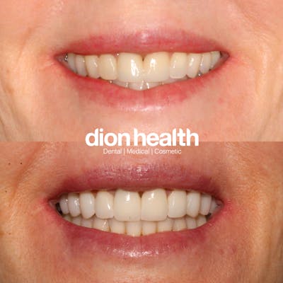 Smile Makeover Before & After Gallery - Patient 177618046 - Image 1