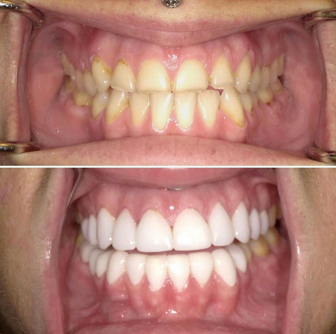 Smile Makeover Before & After Gallery - Patient 207440 - Image 1
