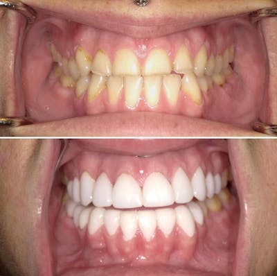 Smile Makeover Before & After Gallery - Patient 207440 - Image 1