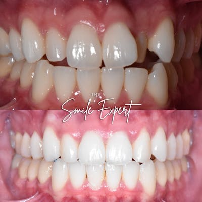 Smile Makeover Before & After Gallery - Patient 101126 - Image 1