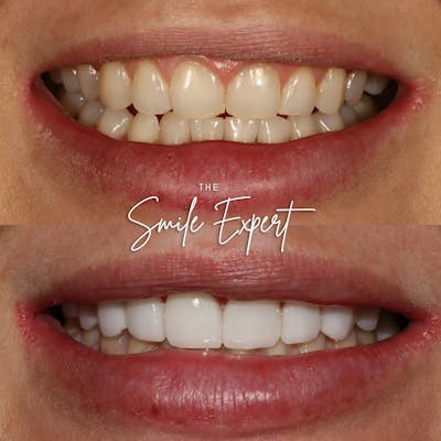 Smile Makeover Before & After Gallery - Patient 438321 - Image 1