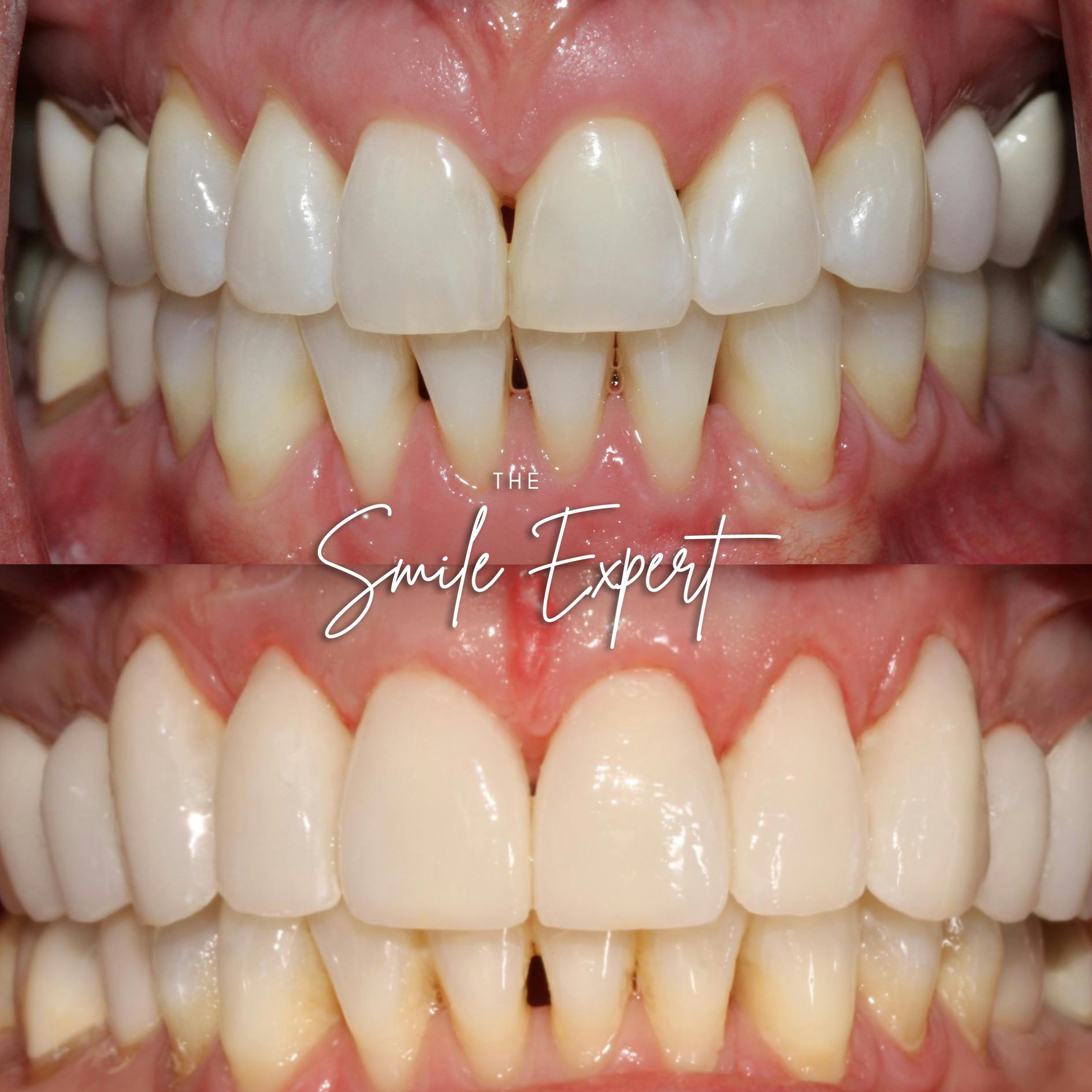 Smile Makeover Before & After Gallery - Patient 212143 - Image 1