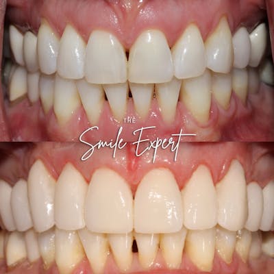 Smile Makeover Before & After Gallery - Patient 212143 - Image 1