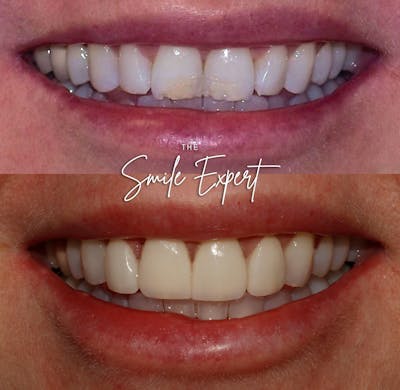 Smile Makeover Before & After Gallery - Patient 191106 - Image 1
