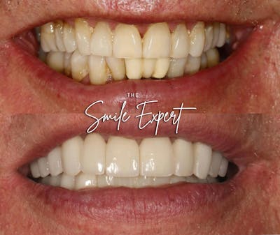 Smile Makeover Before & After Gallery - Patient 283051 - Image 1