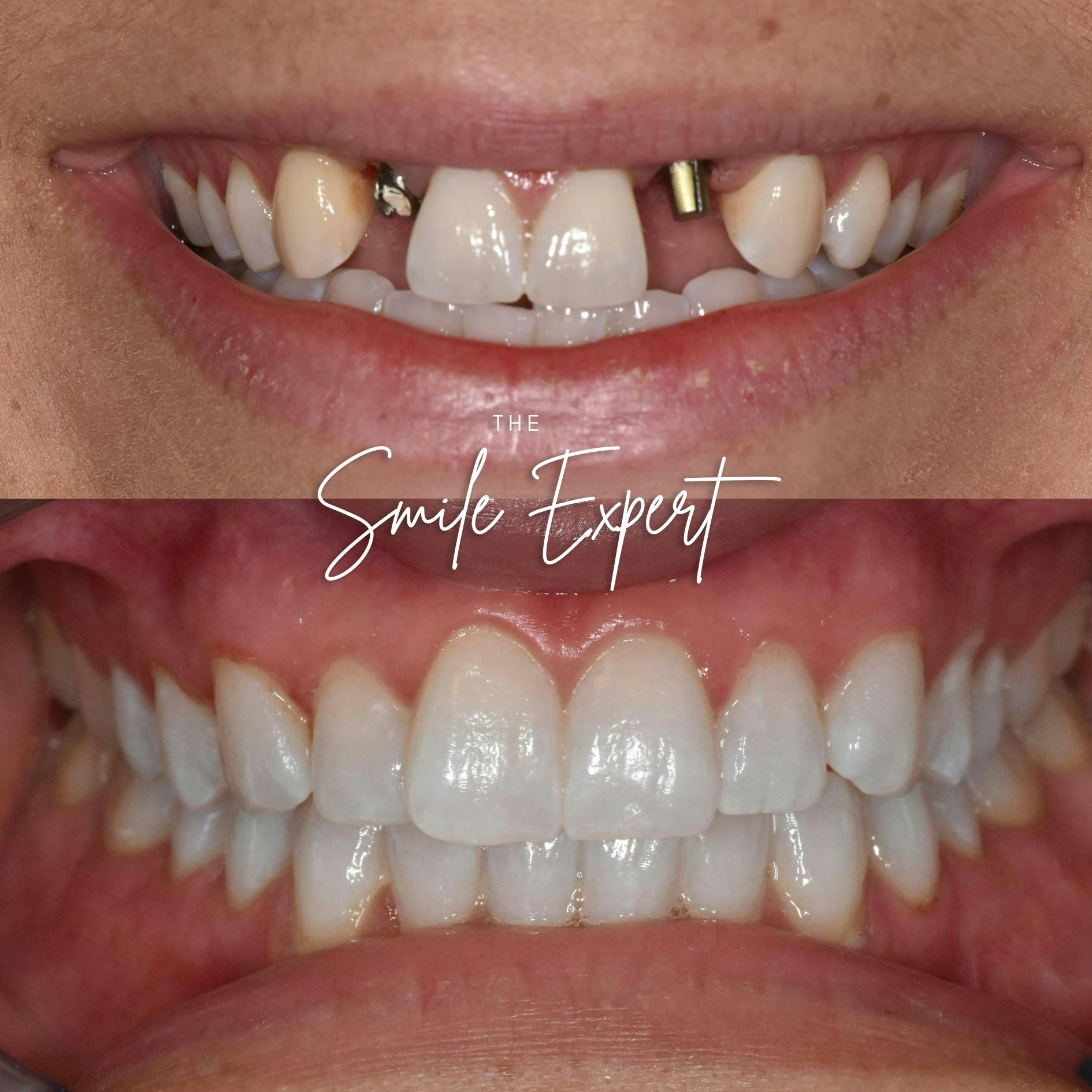 Smile Makeover Before & After Gallery - Patient 343203 - Image 1