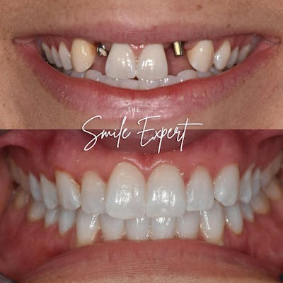 Smile Makeover Before & After Gallery - Patient 343203 - Image 1