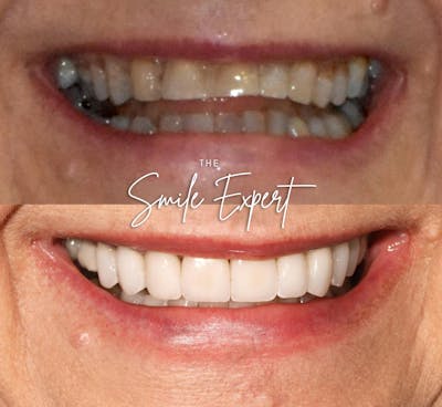 Smile Makeover Before & After Gallery - Patient 511048 - Image 1