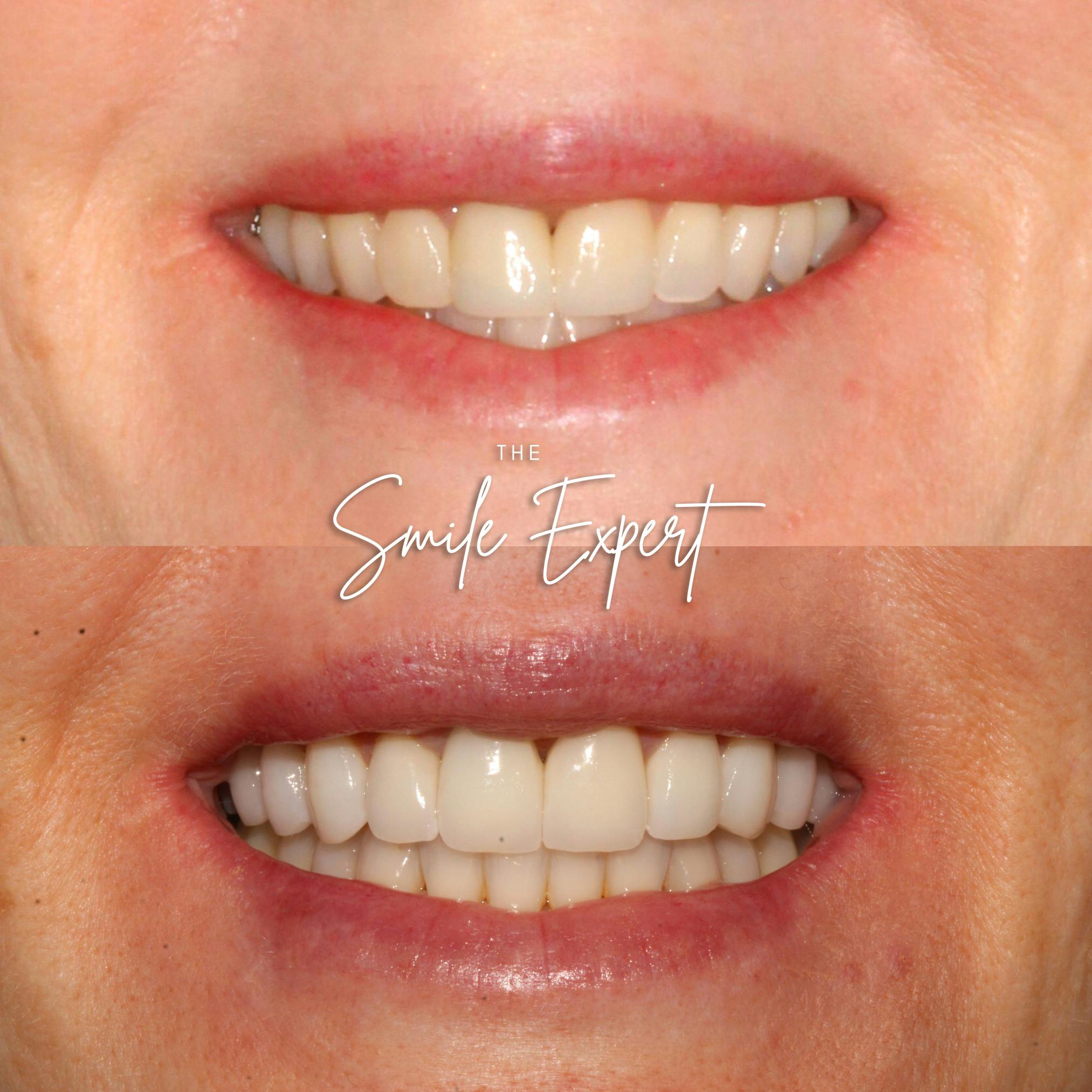 Smile Makeover Before & After Gallery - Patient 308948 - Image 1