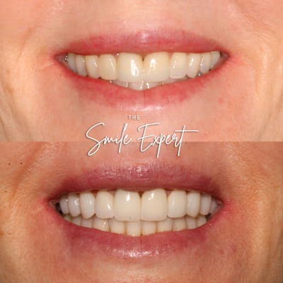 Smile Makeover Before & After Gallery - Patient 308948 - Image 1