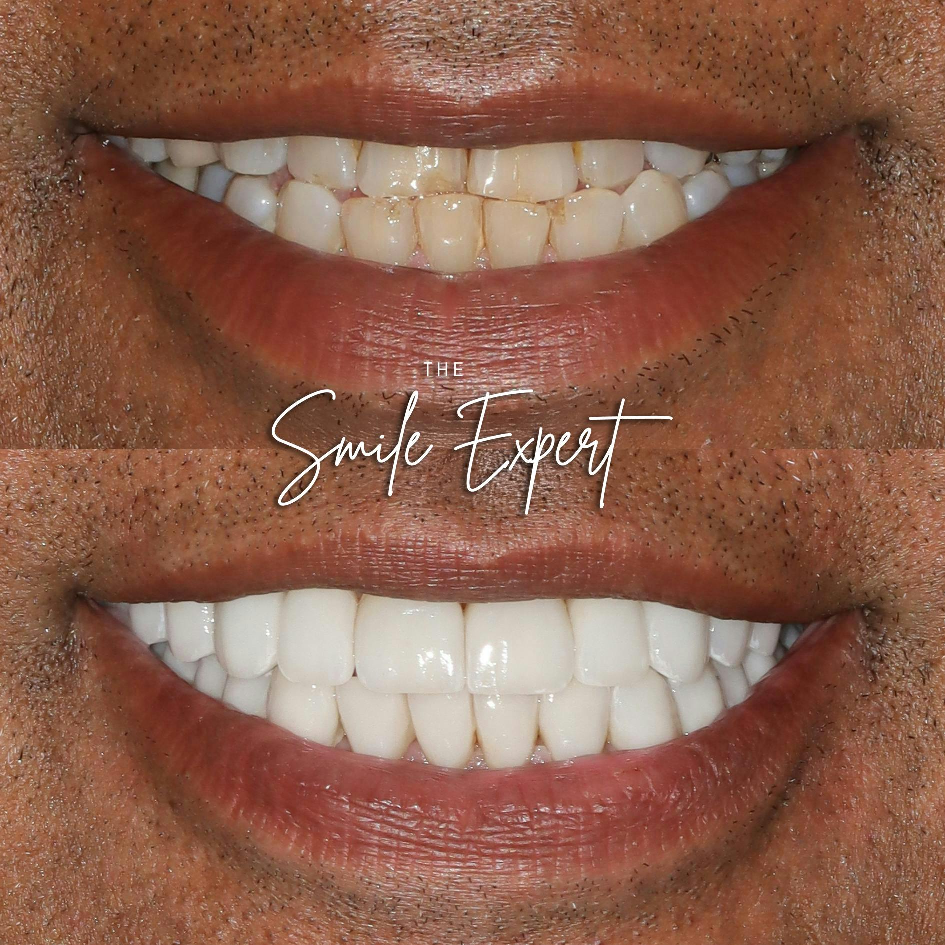 Smile Makeover Before & After Gallery - Patient 318919 - Image 1