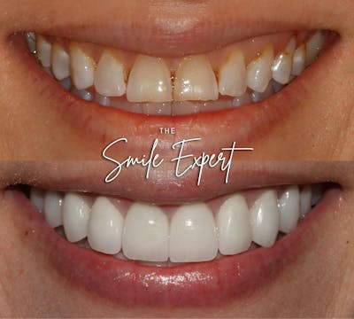 Smile Makeover Before & After Gallery - Patient 328987 - Image 1