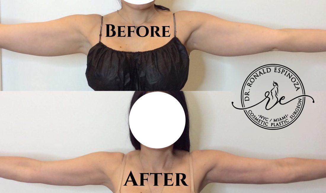 Dr Ronlad Espinoza patient before and after J-Plasma Renuvion