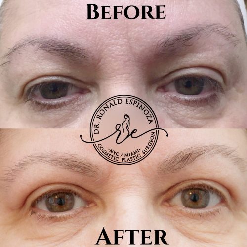 Before and After Blepharoplasty