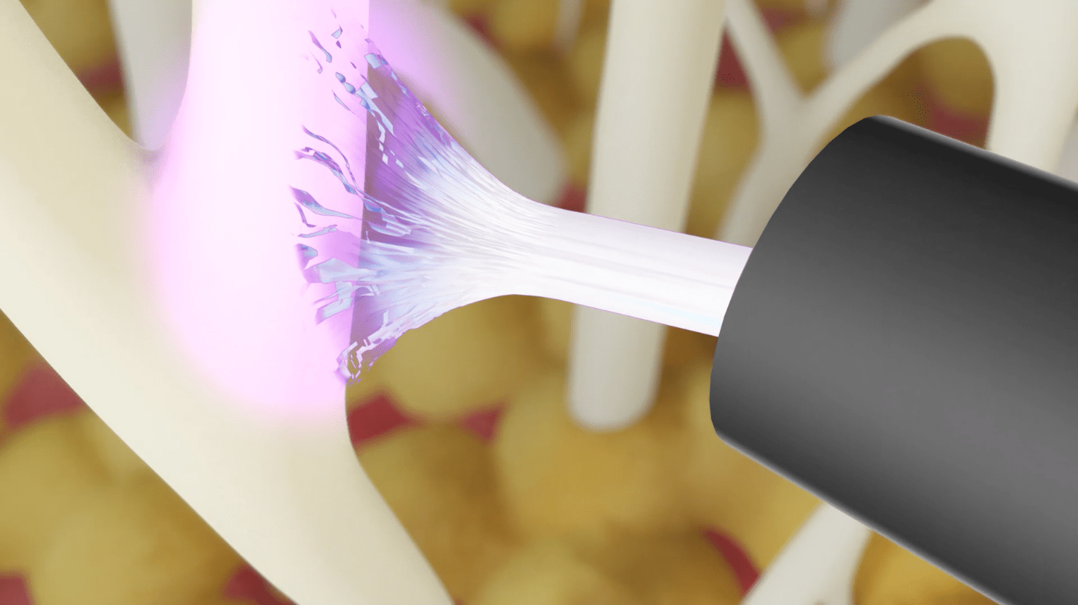 J-Plasma Renuvion illustration