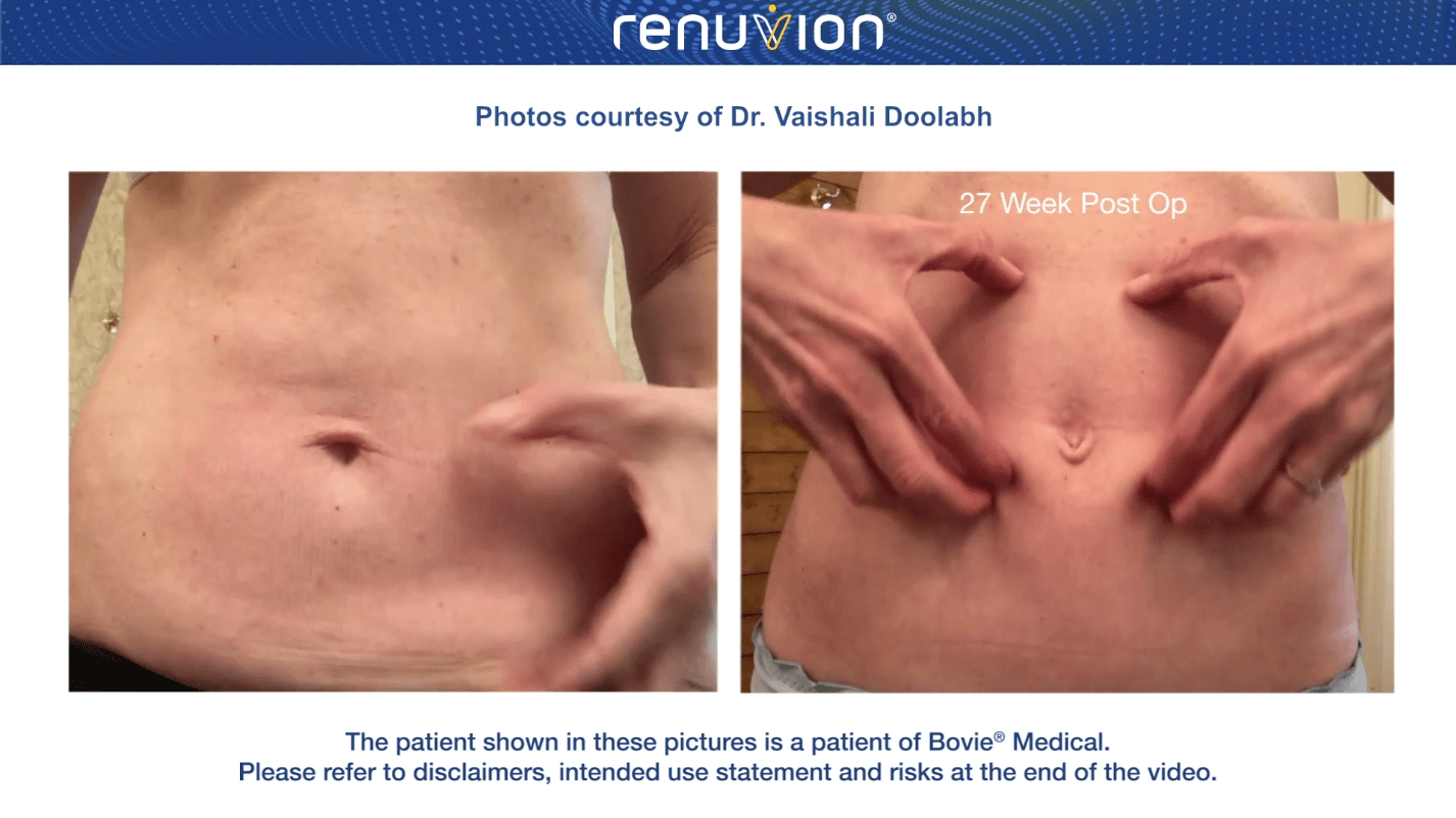 Patient after J-Plasma Renuvion