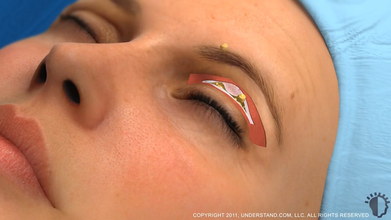 Woman undergoing eyelid surgery
