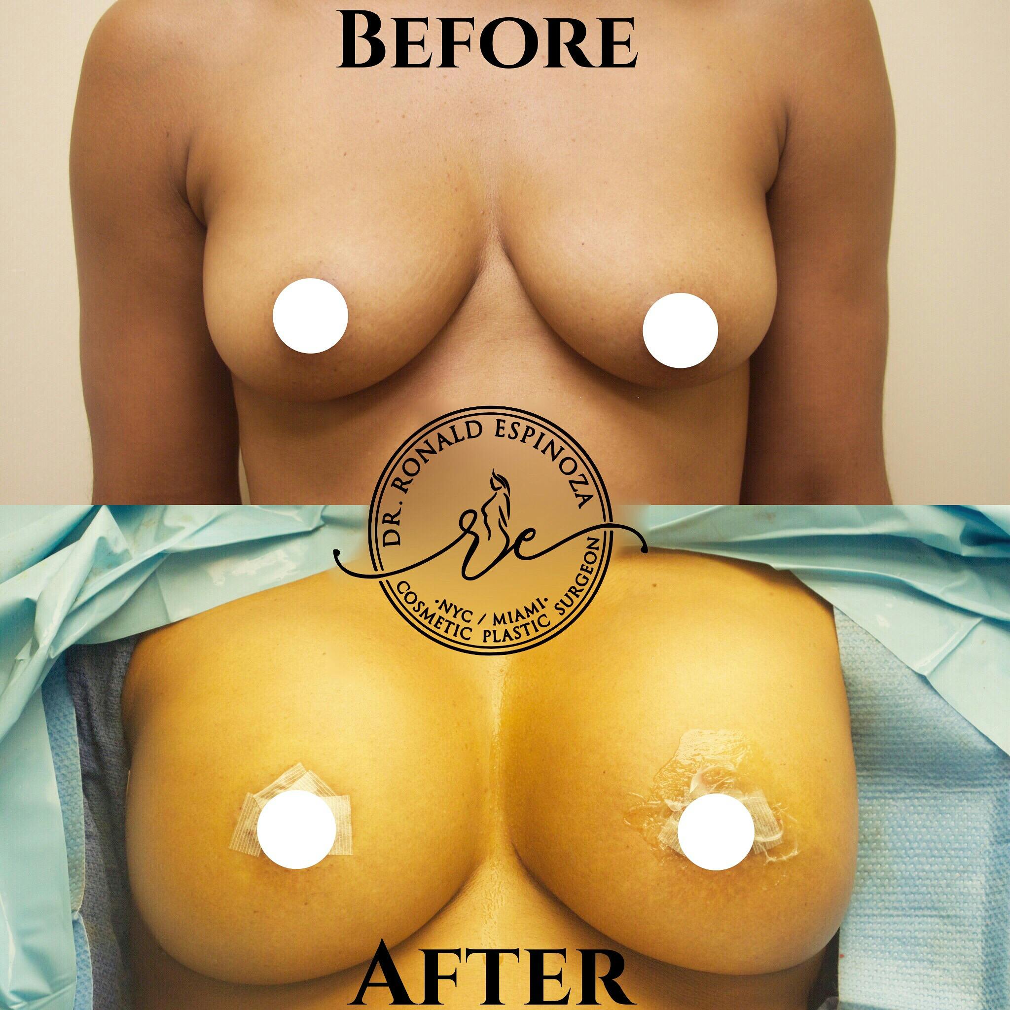 Before and After Breast Augmentation by Dr. Espinoza
